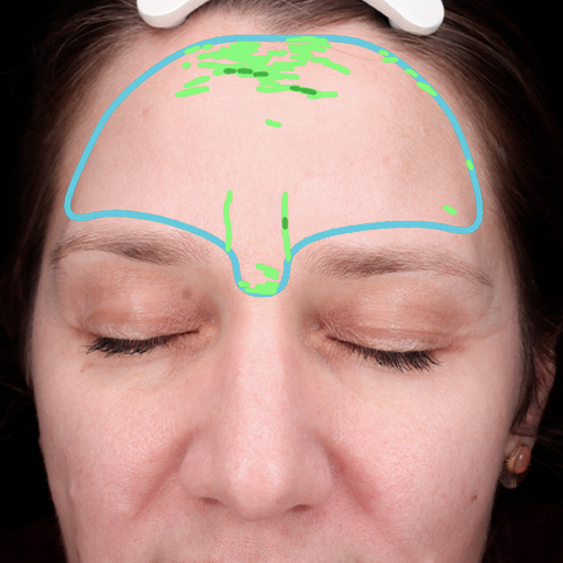 Photo Après d’une femme ayant pris The Solution, la poudre de collagène d’Oslo Skin Lab. Elle s’appelle Laetitia.