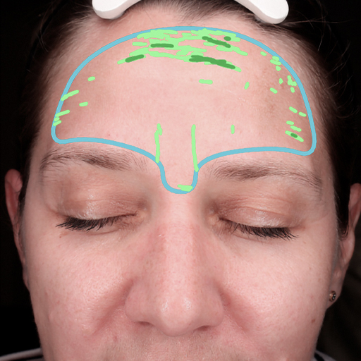Photo d’une femme avant d'avoir pris The Solution, la poudre de collagène d’Oslo Skin Lab. Elle s’appelle Laetitia.