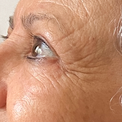 Photo montrant la réduction des rides d'une mamie de 71 ans après 7 mois de prise de collagène Oslo Skin Lab