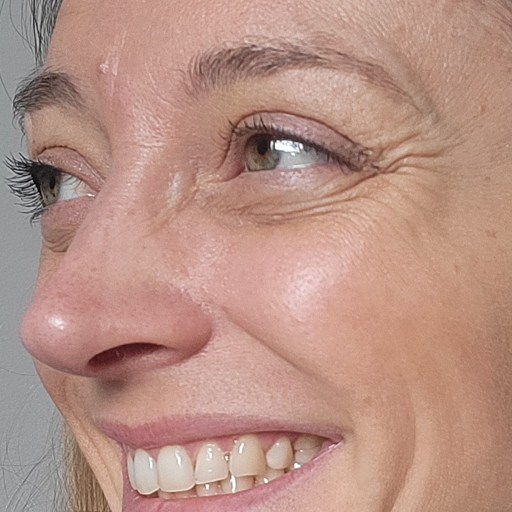 Photo montrant les rides de Morgane M avant la prise du collagène de Oslo Skin Lab