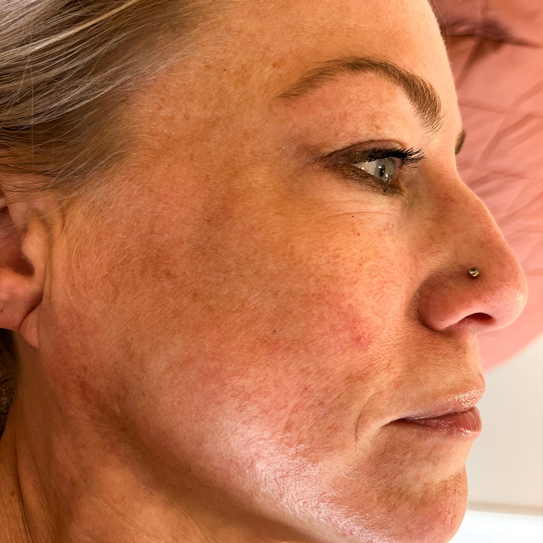 Photo Avant d’une femme ayant pris The Solution, la poudre de collagène d’Oslo Skin Lab. Elle s’appelle Amanda.