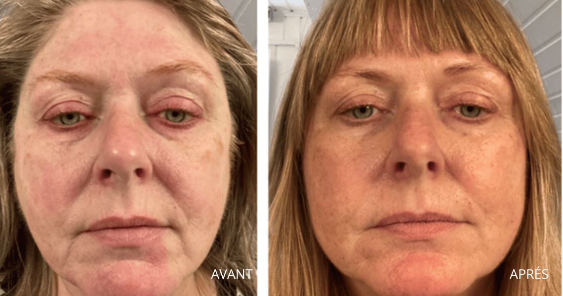 Avant Après Annemette -cliente Oslo Skin Lab