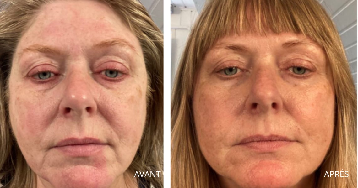 Avant Après Annemette -cliente Oslo Skin Lab