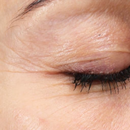 Photo montrant la réduction des rides de Silke Grane après la prise du collagène de Oslo Skin Lab