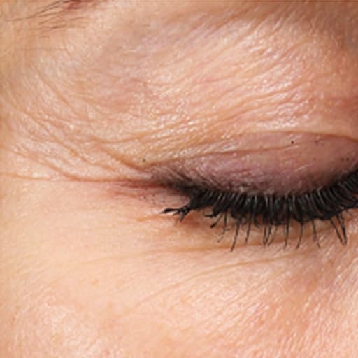 Photo montrant les rides de Silke Grane avant la prise du collagène de Oslo Skin Lab