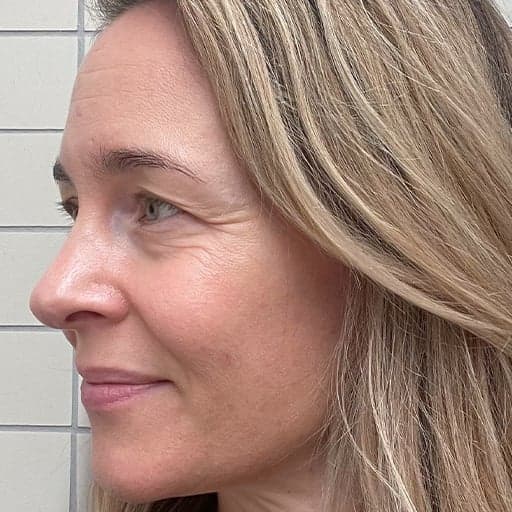 Photo d'une femme avant de commencer à prendre The Solution, la poudre de collagène d’Oslo Skin Lab.  Elle s’appelle Charlotte