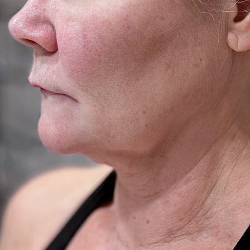 Photo d'une femme avant de commencer à prendre The Solution, la poudre de collagène d’Oslo Skin Lab.  Elle s’appelle Helen