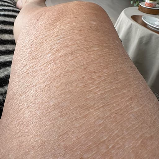Photo d'une femme avant de commencer à prendre The Solution, la poudre de collagène d’Oslo Skin Lab.  Elle s’appelle Jette