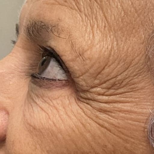 Photo montrant les rides d'une mamie de 71 ans avant la prise de collagène Oslo Skin Lab