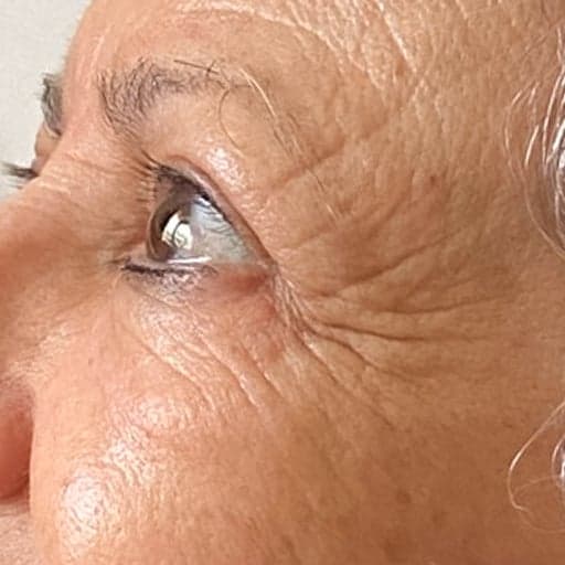 Photo montrant la réduction des rides d'une mamie de 71 ans après 7 mois de prise de collagène Oslo Skin Lab