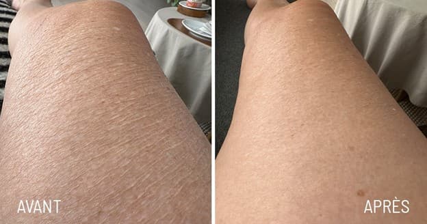 Avant Après Jette -cliente Oslo Skin Lab